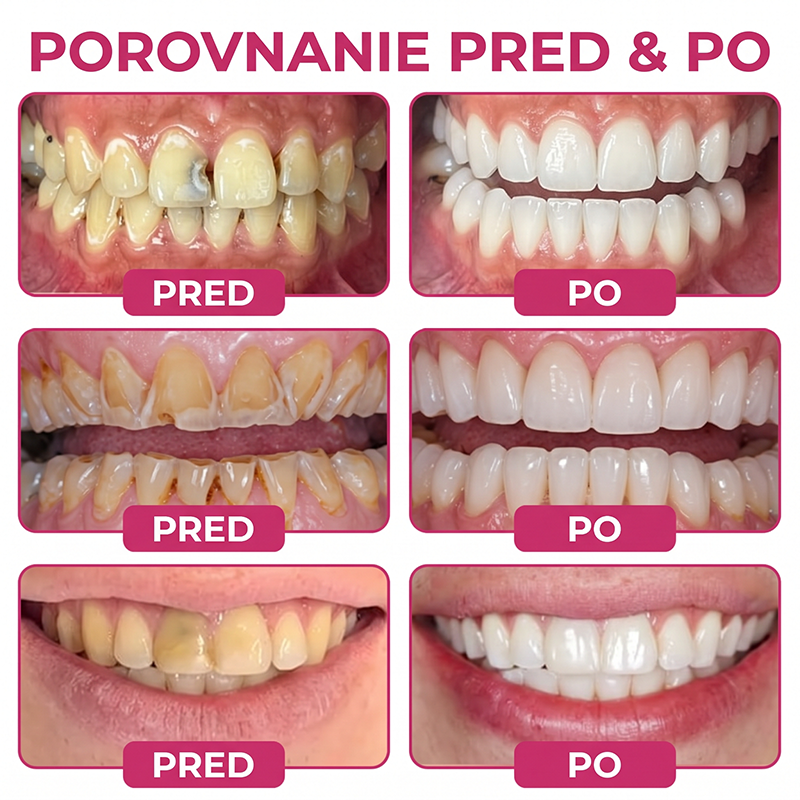 Rolimey® DenPerm – Prírodný gél na vypĺňanie defektov skloviny pri liečbe kazových lézií🧨