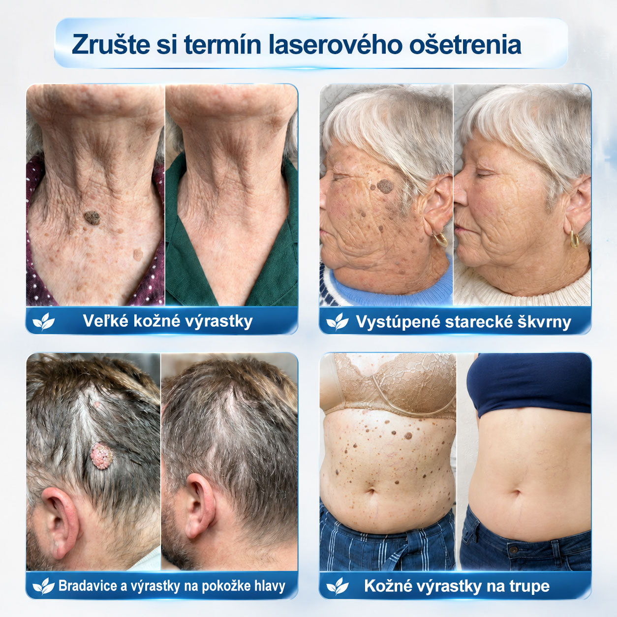 𝐎𝐟𝐢𝐜𝐢𝐚𝐥𝐧𝐲 𝐨𝐛𝐜𝐡𝐨𝐝 𝐦𝐚𝐫𝐤𝐲 | ✅️👩‍⚕️𝐏i𝐜𝐝o® 7dni Prípravok na odstránenie kožných výrastkov a pigmentových škvŕn (bezbolestný roll-on aplikátor bez jaziev) ⭐