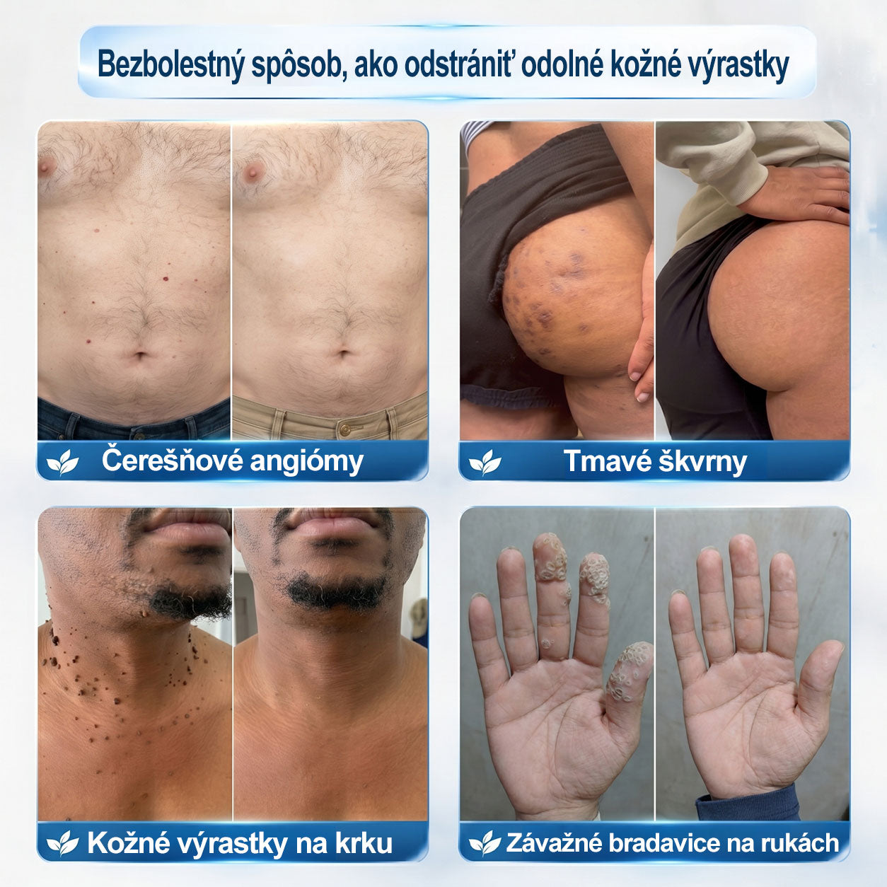 𝐎𝐟𝐢𝐜𝐢𝐚𝐥𝐧𝐲 𝐨𝐛𝐜𝐡𝐨𝐝 𝐦𝐚𝐫𝐤𝐲 | ✅️👩‍⚕️𝐏i𝐜𝐝o® 7dni Prípravok na odstránenie kožných výrastkov a pigmentových škvŕn (bezbolestný roll-on aplikátor bez jaziev) ⭐