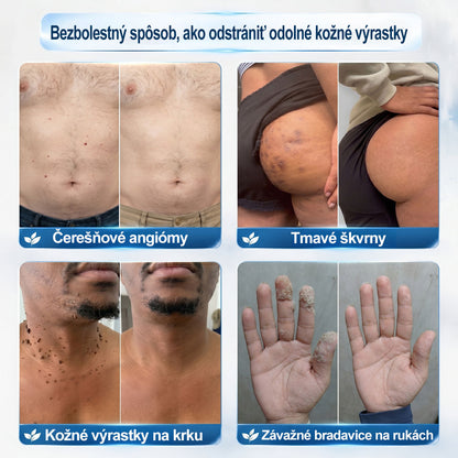 𝐎𝐟𝐢𝐜𝐢𝐚𝐥𝐧𝐲 𝐨𝐛𝐜𝐡𝐨𝐝 𝐦𝐚𝐫𝐤𝐲 | ✅️👩‍⚕️𝐏i𝐜𝐝o® 7dni Prípravok na odstránenie kožných výrastkov a pigmentových škvŕn (bezbolestný roll-on aplikátor bez jaziev) ⭐