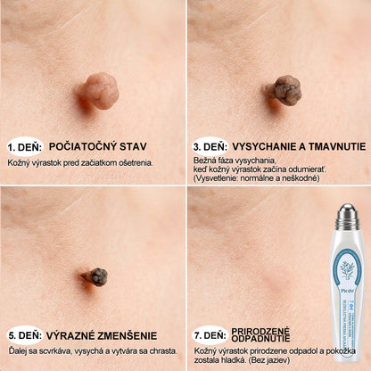 𝐎𝐟𝐢𝐜𝐢𝐚𝐥𝐧𝐲 𝐨𝐛𝐜𝐡𝐨𝐝 𝐦𝐚𝐫𝐤𝐲 | ✅️👩‍⚕️𝐏i𝐜𝐝o® 7dni Prípravok na odstránenie kožných výrastkov a pigmentových škvŕn (bezbolestný roll-on aplikátor bez jaziev) ⭐