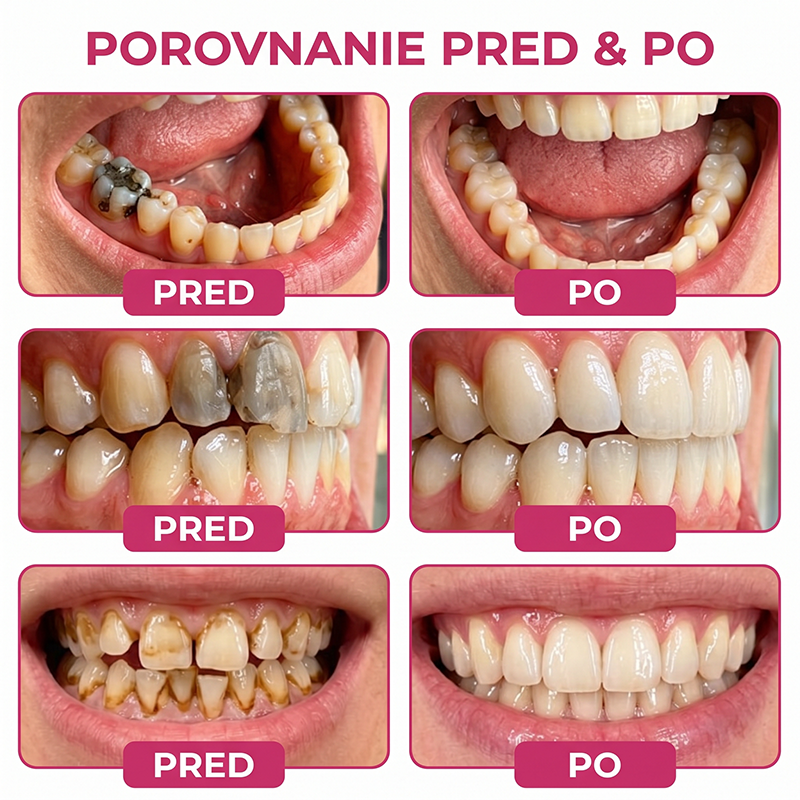 Rolimey® DenPerm – Prírodný gél na vypĺňanie defektov skloviny pri liečbe kazových lézií🧨